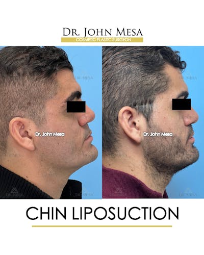 Chin Liposuction Before & After Gallery - Patient 174902008 - Image 1