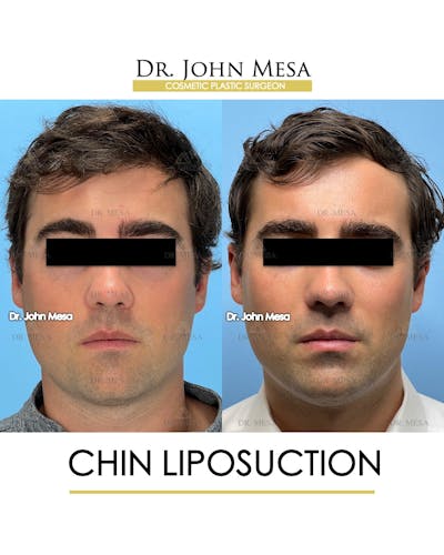 Chin Liposuction Before & After Gallery - Patient 174902005 - Image 2