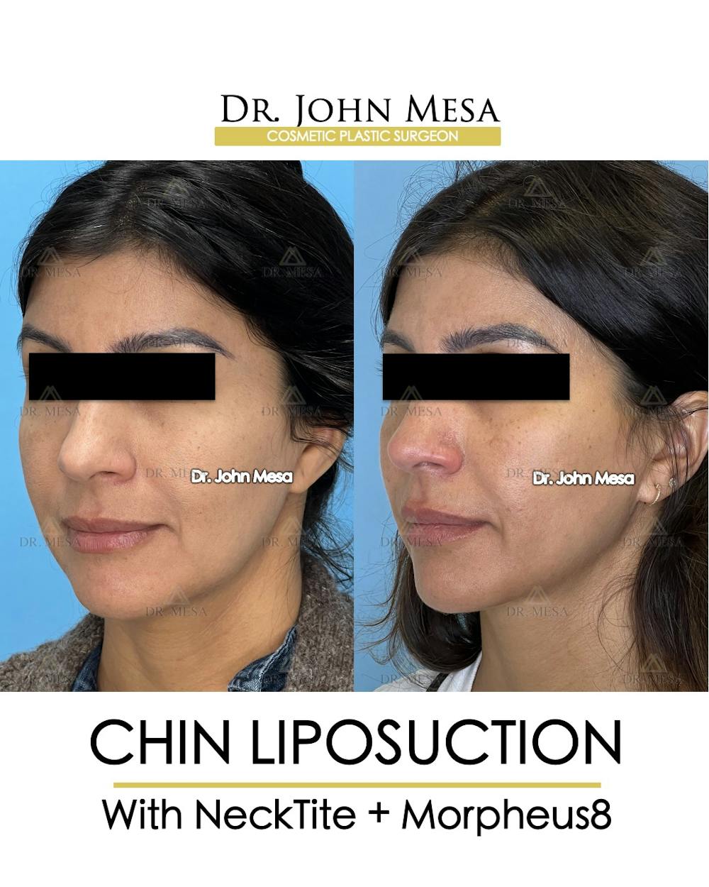 Chin Liposuction Before & After Gallery - Patient 174902409 - Image 4