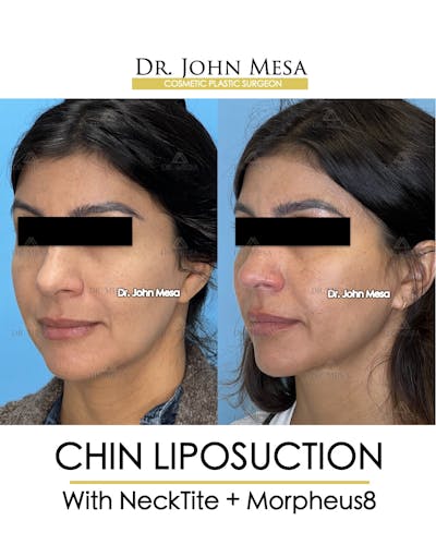 Chin Liposuction Before & After Gallery - Patient 174902409 - Image 4