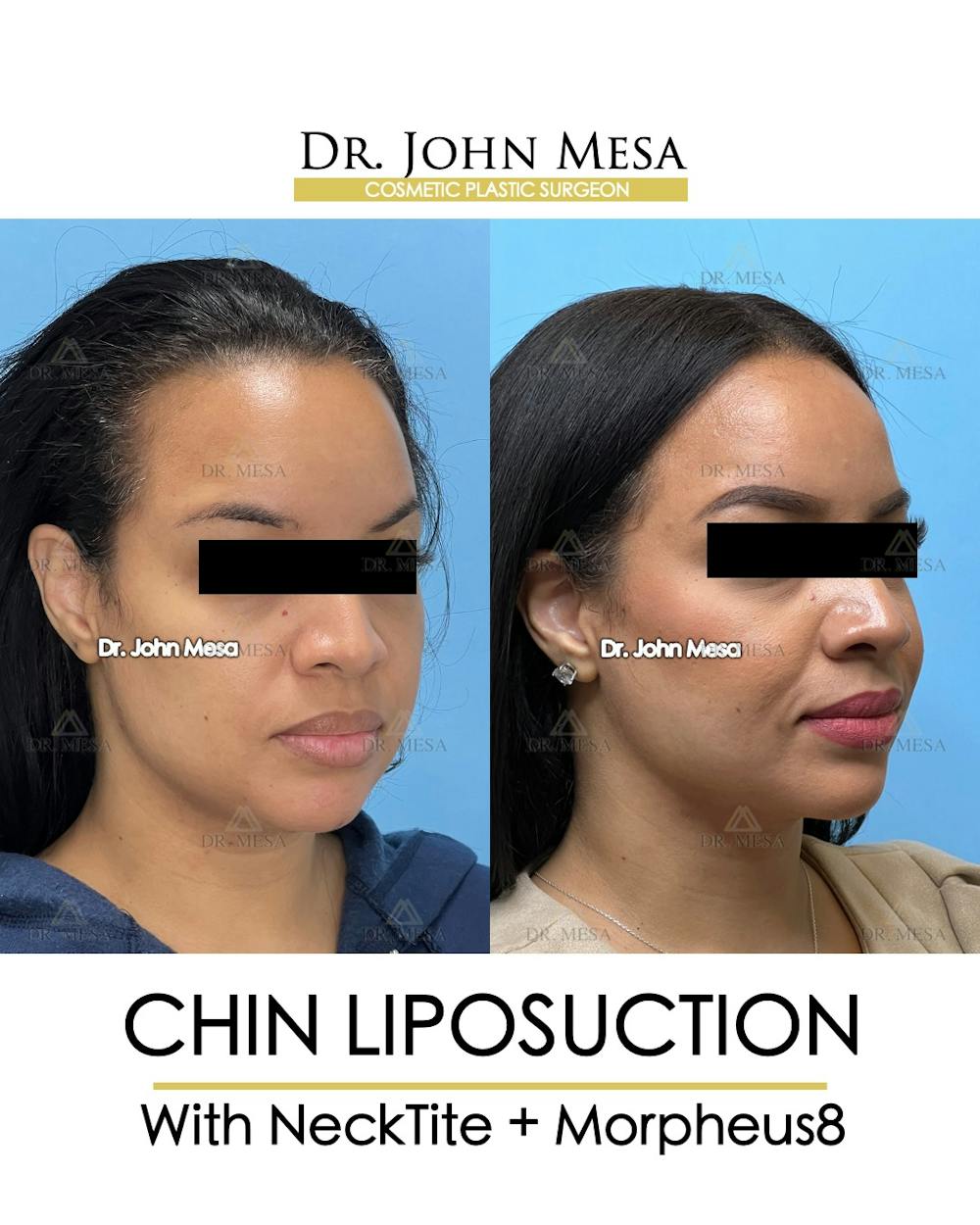 Chin Liposuction Before & After Gallery - Patient 174902184 - Image 3