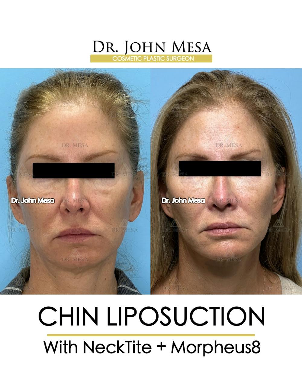 Chin Liposuction Before & After Gallery - Patient 174902408 - Image 1