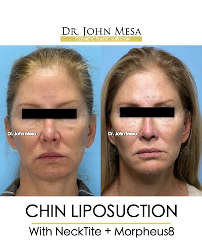 Chin Liposuction Before & After Gallery - Patient 174902408 - Image 2