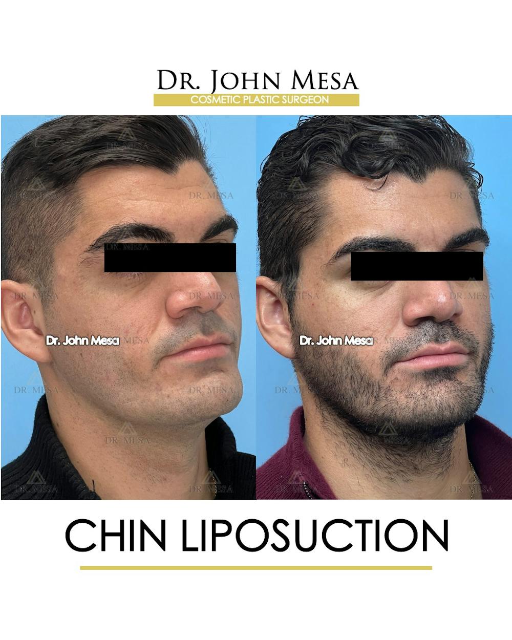 Chin Liposuction Before & After Gallery - Patient 174902008 - Image 3