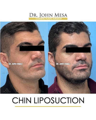 Chin Liposuction Before & After Gallery - Patient 174902008 - Image 2
