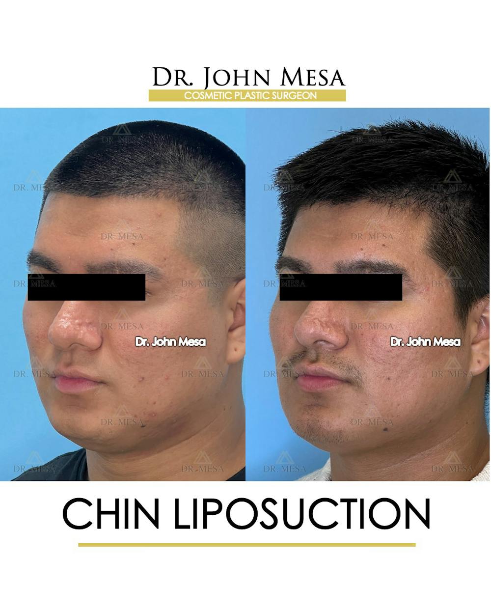 Chin Liposuction Before & After Gallery - Patient 174902006 - Image 4