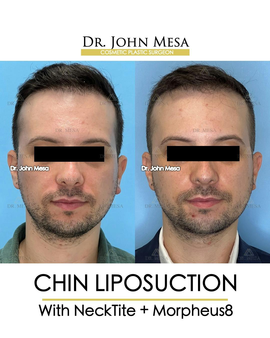 Chin Liposuction Before & After Gallery - Patient 174902009 - Image 1