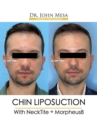Chin Liposuction Before & After Gallery - Patient 174902009 - Image 1