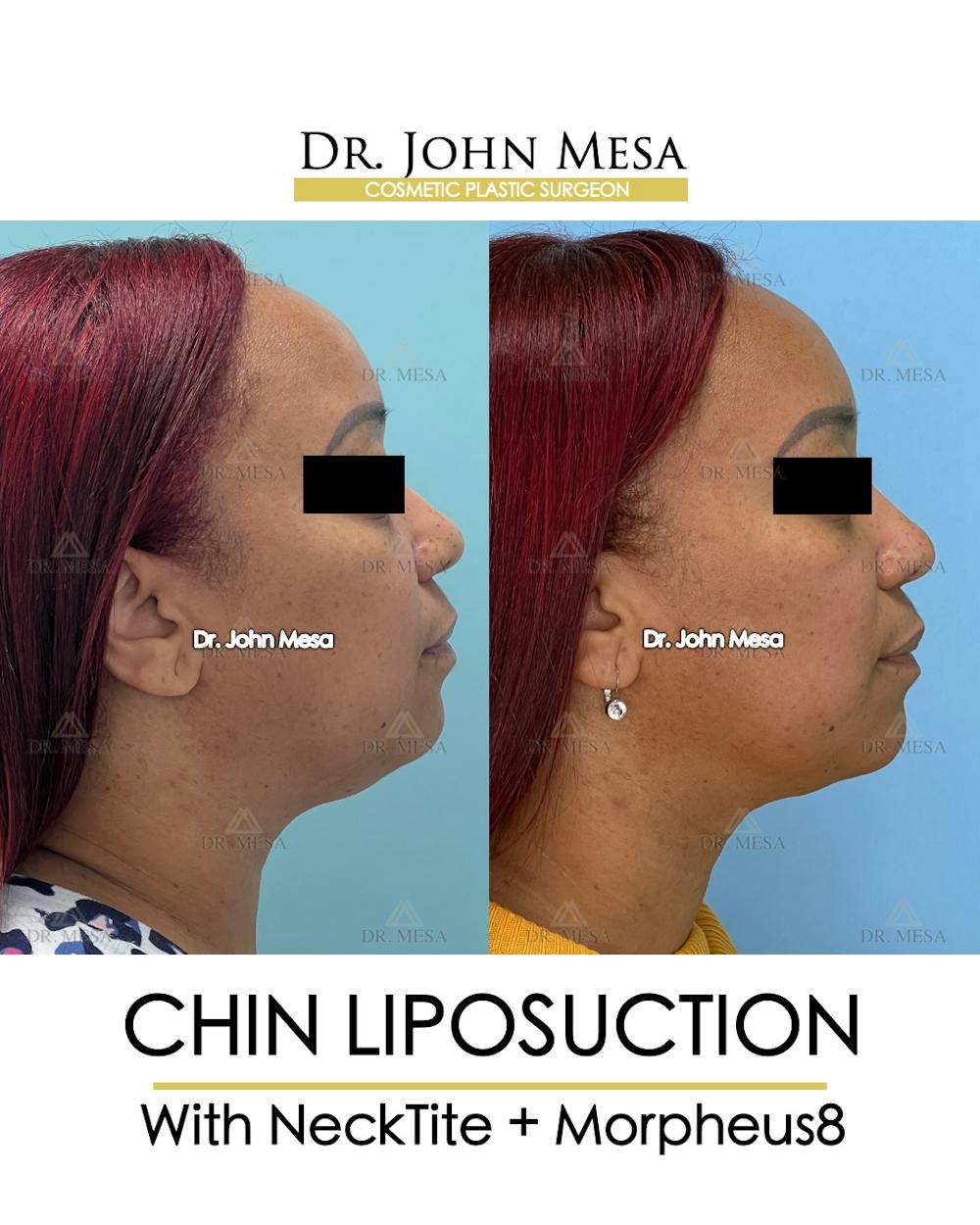 Chin Liposuction Before & After Gallery - Patient 174902327 - Image 1