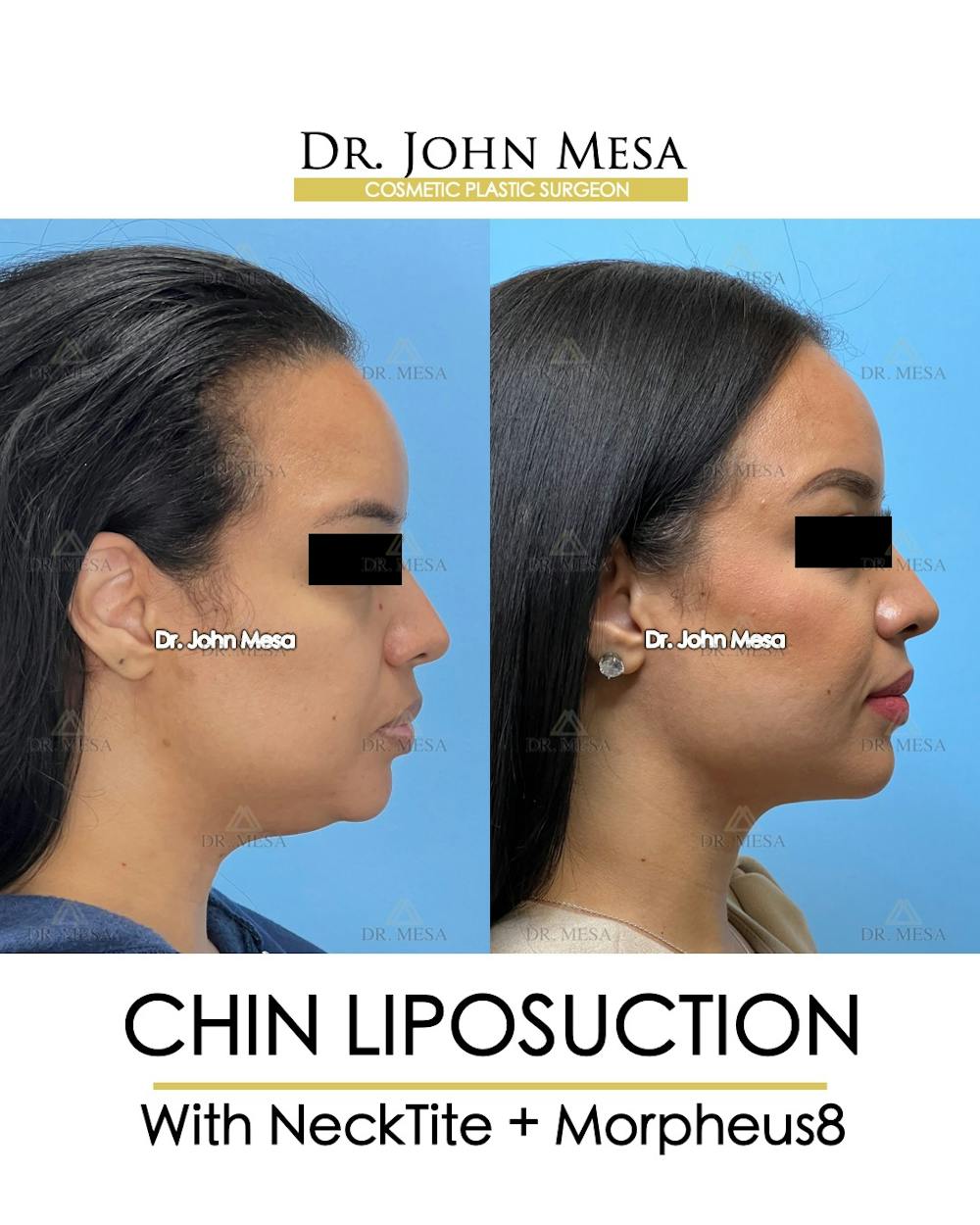 Chin Liposuction Before & After Gallery - Patient 174902184 - Image 3