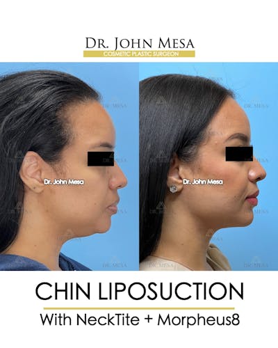 Chin Liposuction Before & After Gallery - Patient 174902184 - Image 1