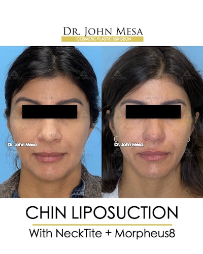 Chin Liposuction Before & After Gallery - Patient 174902409 - Image 1