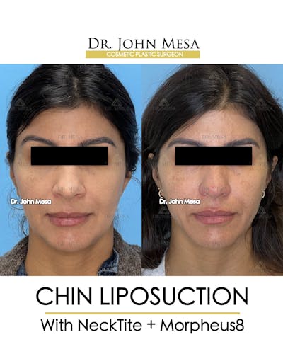 Chin Liposuction Before & After Gallery - Patient 174902409 - Image 2