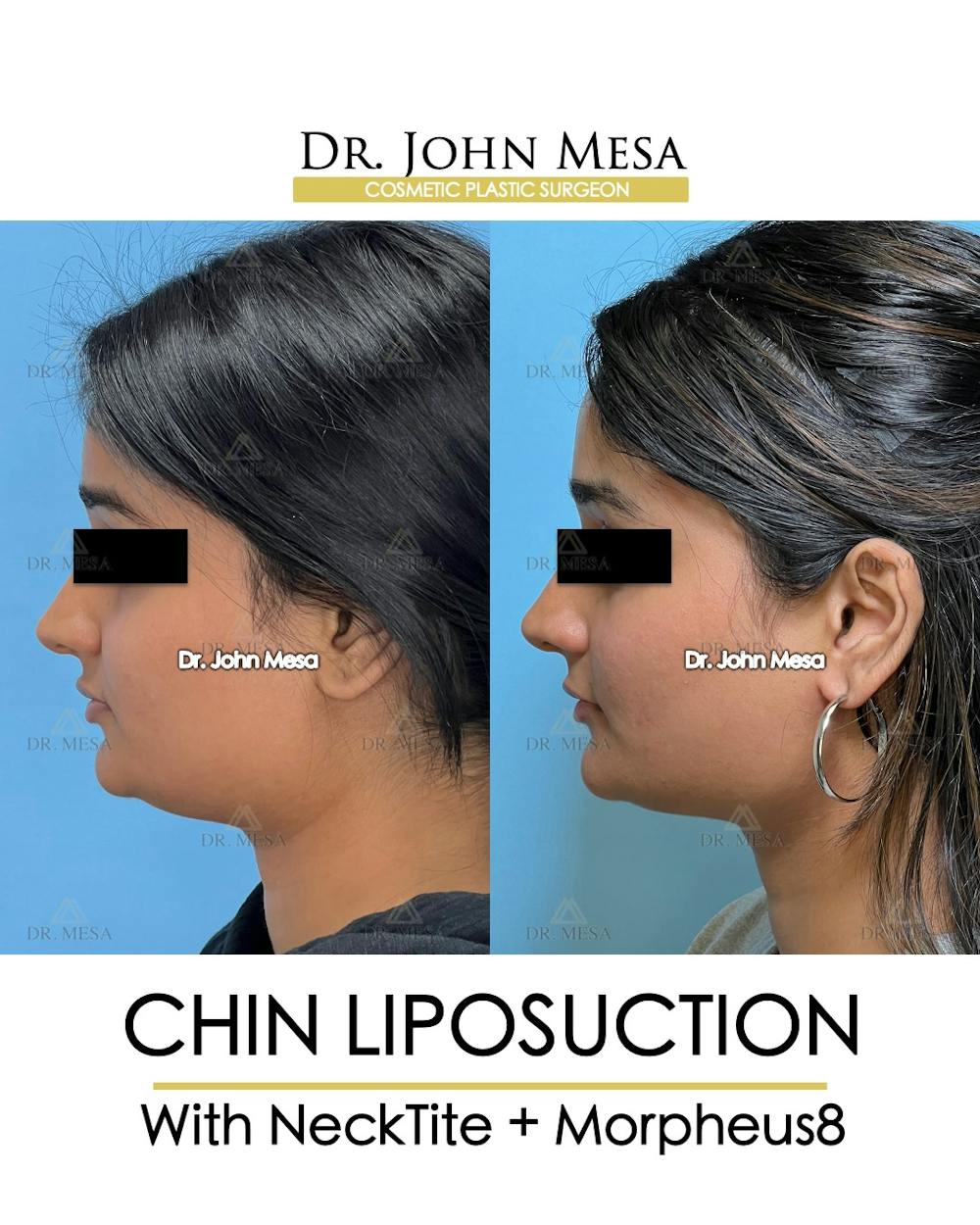 Chin Liposuction Before & After Gallery - Patient 174902185 - Image 5