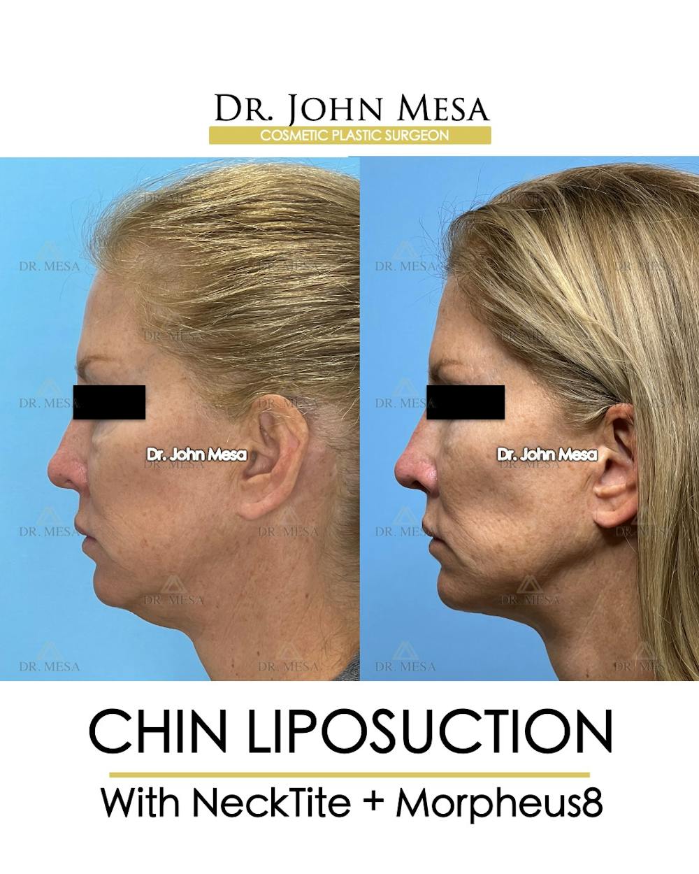 Chin Liposuction Before & After Gallery - Patient 174902408 - Image 5