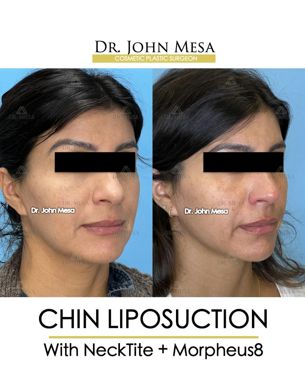 Chin Liposuction Before & After Gallery - Patient 174902409 - Image 3