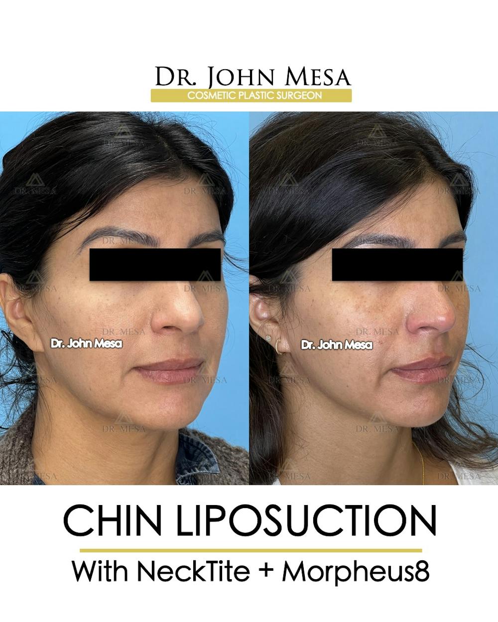 NeckTite Before & After Gallery - Patient 174971289 - Image 2