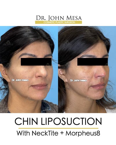 NeckTite Before & After Gallery - Patient 174971289 - Image 2