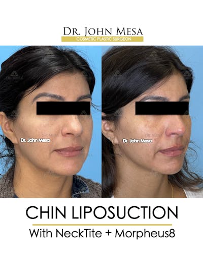 Chin Liposuction Before & After Gallery - Patient 174902409 - Image 2