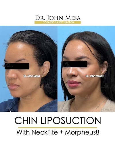 Chin Liposuction Before & After Gallery - Patient 174902184 - Image 4