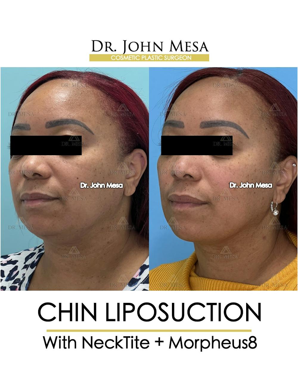 Chin Liposuction Before & After Gallery - Patient 174902327 - Image 4