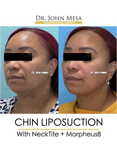 Chin Liposuction Before & After Gallery - Patient 174902327 - Image 4