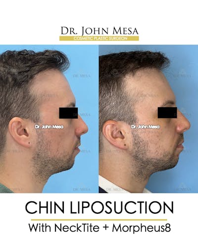 Chin Liposuction Before & After Gallery - Patient 174902009 - Image 2