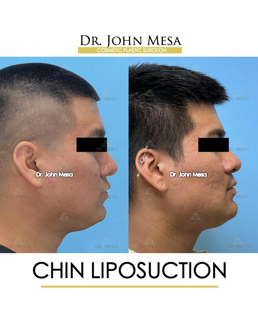 Chin Liposuction Before & After Gallery - Patient 174902006 - Image 3