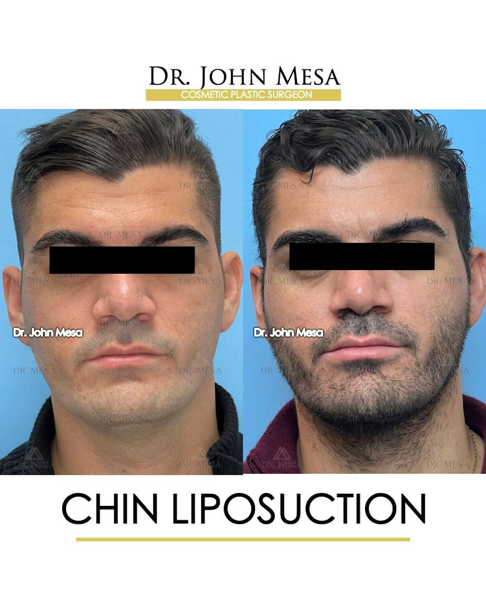 Chin Liposuction Before & After Gallery - Patient 174902008 - Image 2