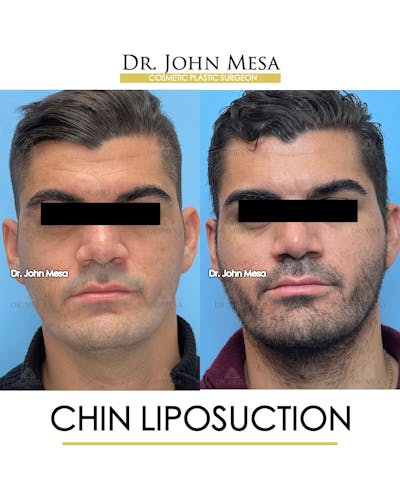 Chin Liposuction Before & After Gallery - Patient 174902008 - Image 1