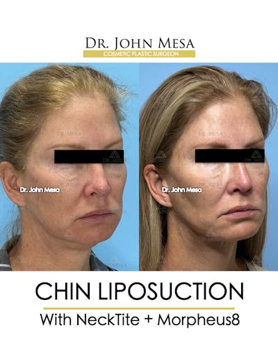 Chin Liposuction Before & After Gallery - Patient 174902408 - Image 2