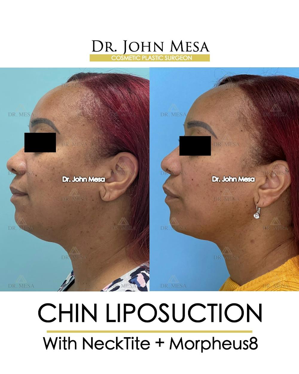 Chin Liposuction Before & After Gallery - Patient 174902327 - Image 5
