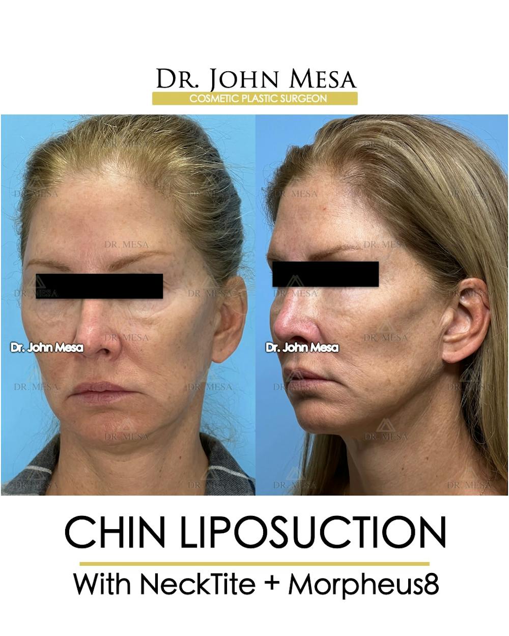 Chin Liposuction Before & After Gallery - Patient 174902408 - Image 3