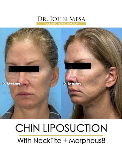 Chin Liposuction Before & After Gallery - Patient 174902408 - Image 4