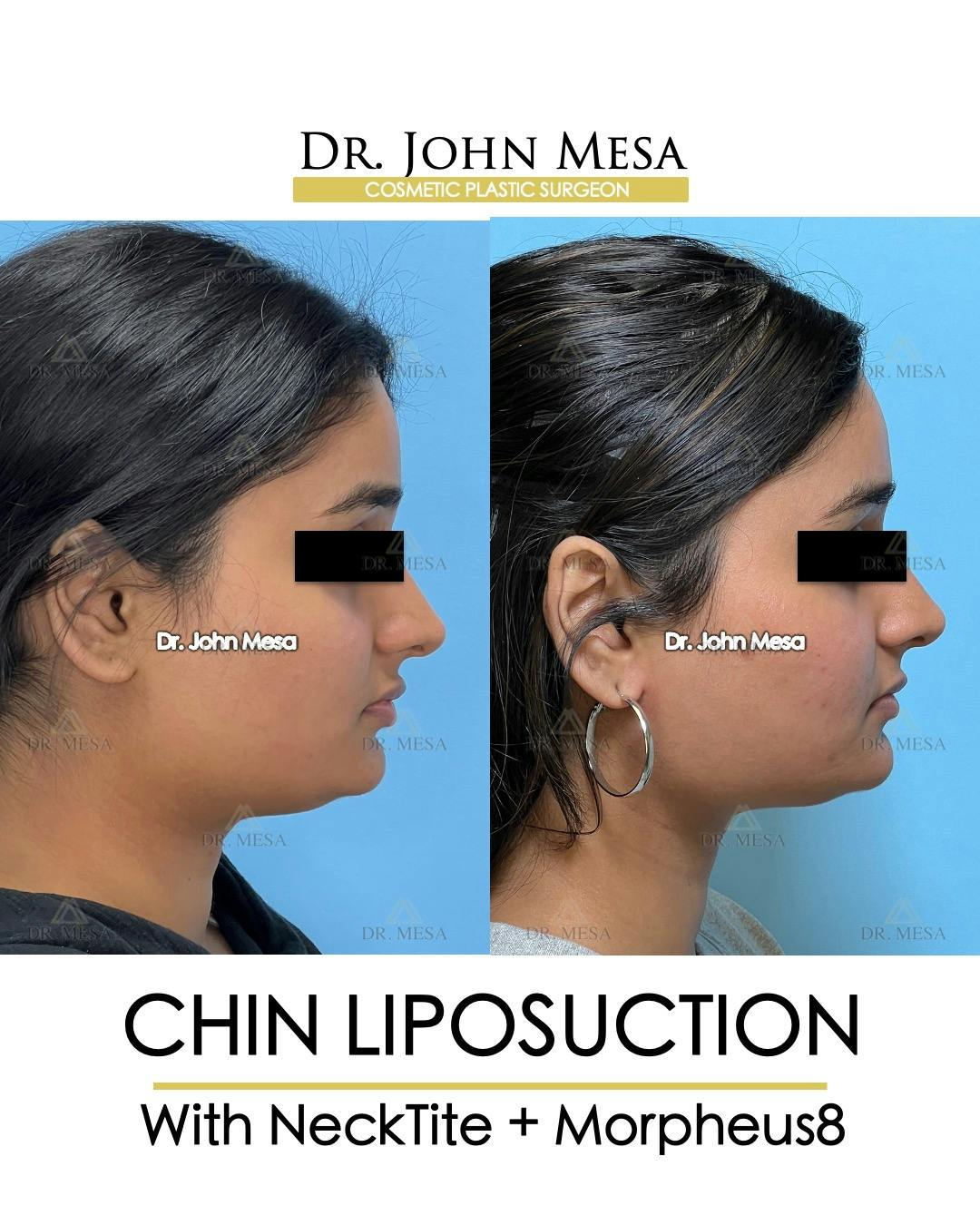 Chin Liposuction Before & After Gallery - Patient 174902185 - Image 1