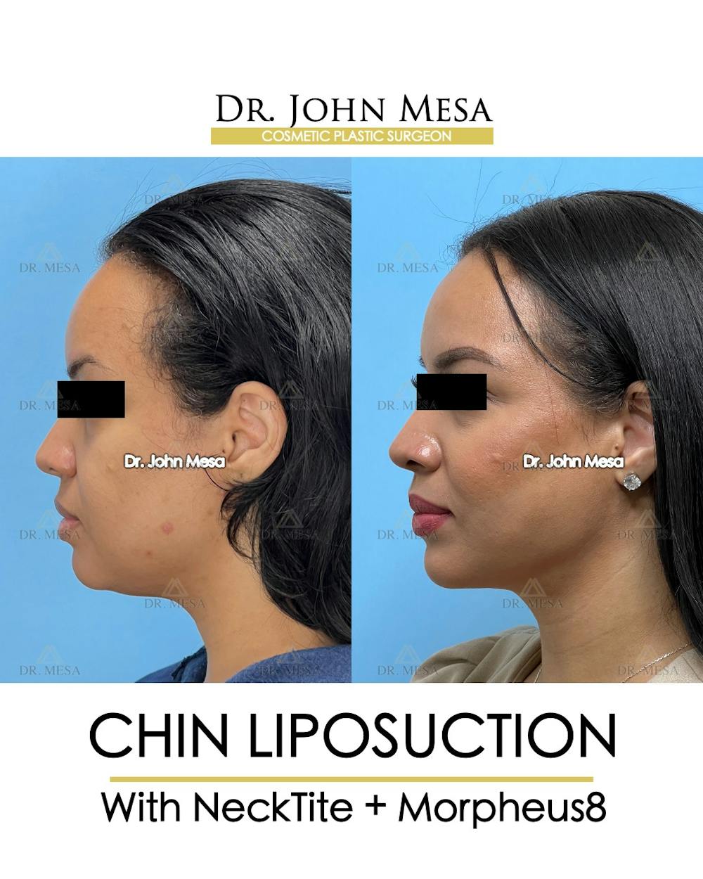 Chin Liposuction Before & After Gallery - Patient 174902184 - Image 5