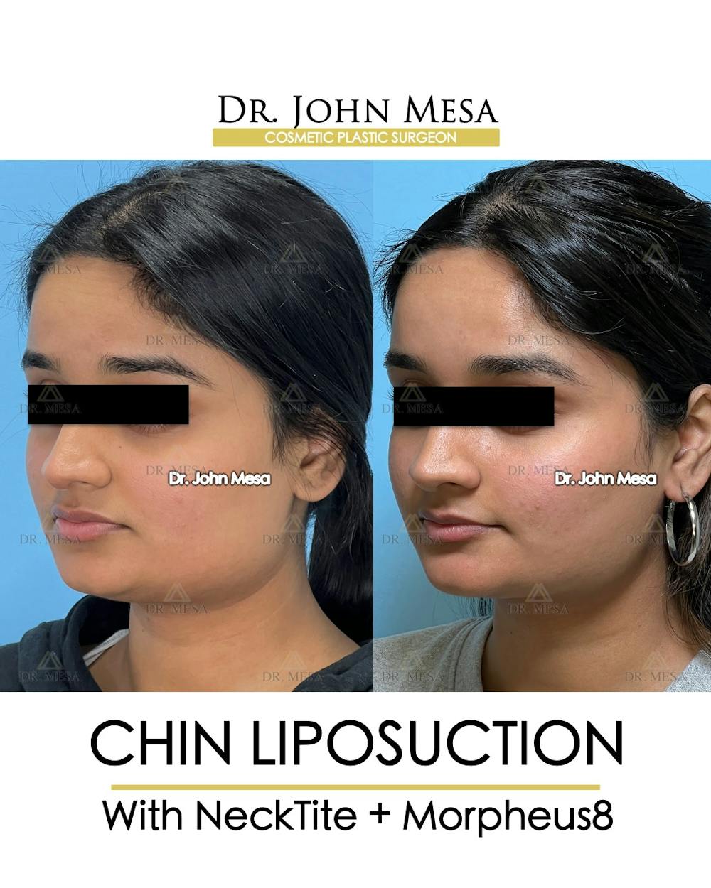 Chin Liposuction Before & After Gallery - Patient 174902185 - Image 4
