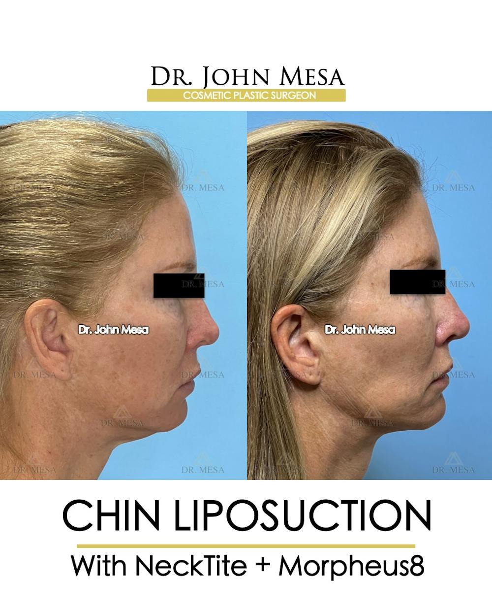 Chin Liposuction Before & After Gallery - Patient 174902408 - Image 1