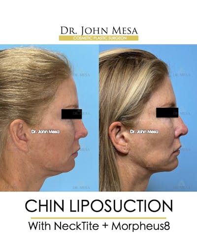 Chin Liposuction Before & After Gallery - Patient 174902408 - Image 1