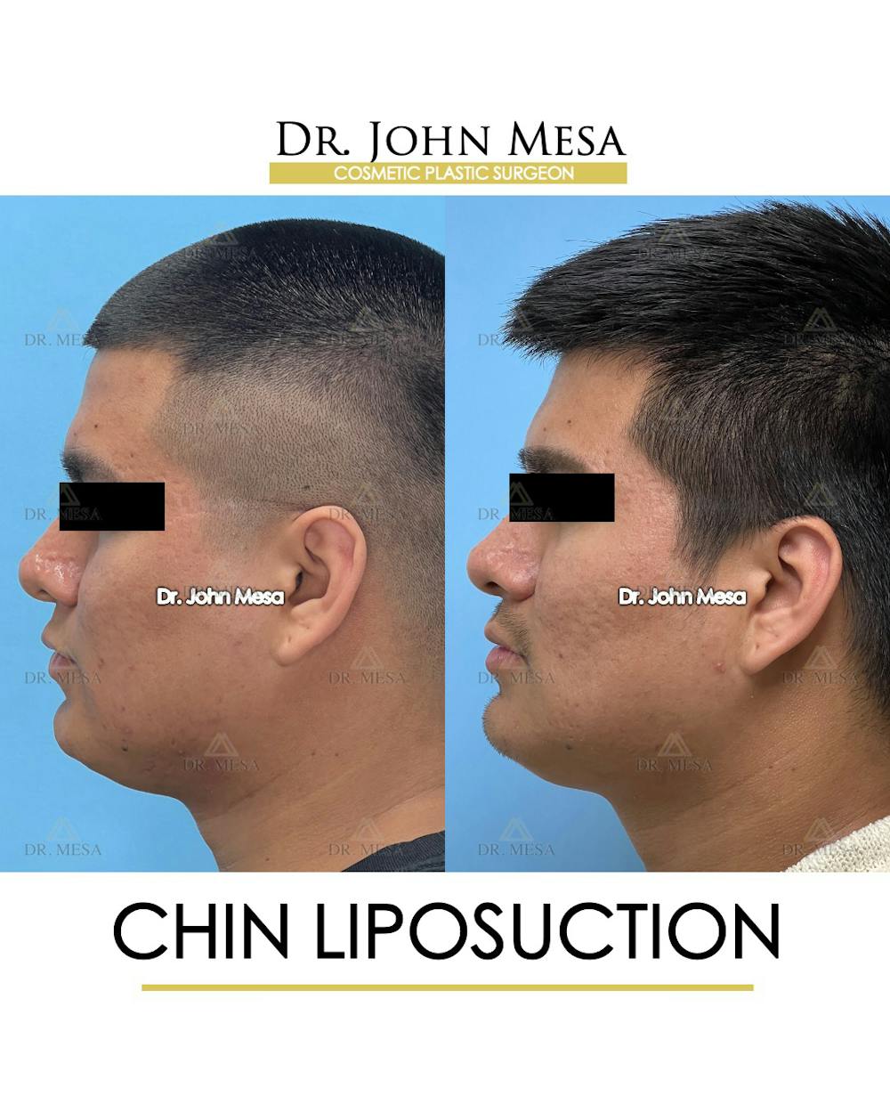 Chin Liposuction Before & After Gallery - Patient 174902006 - Image 5