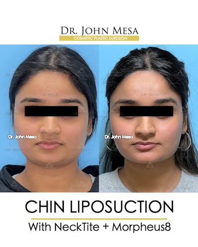 Chin Liposuction Before & After Gallery - Patient 174902185 - Image 1