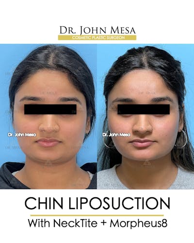 Chin Liposuction Before & After Gallery - Patient 174902185 - Image 2