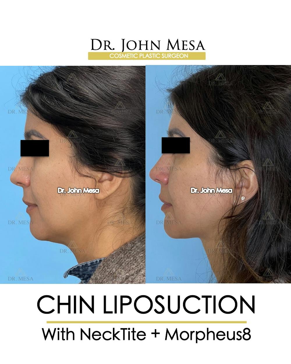 Chin Liposuction Before & After Gallery - Patient 174902409 - Image 5