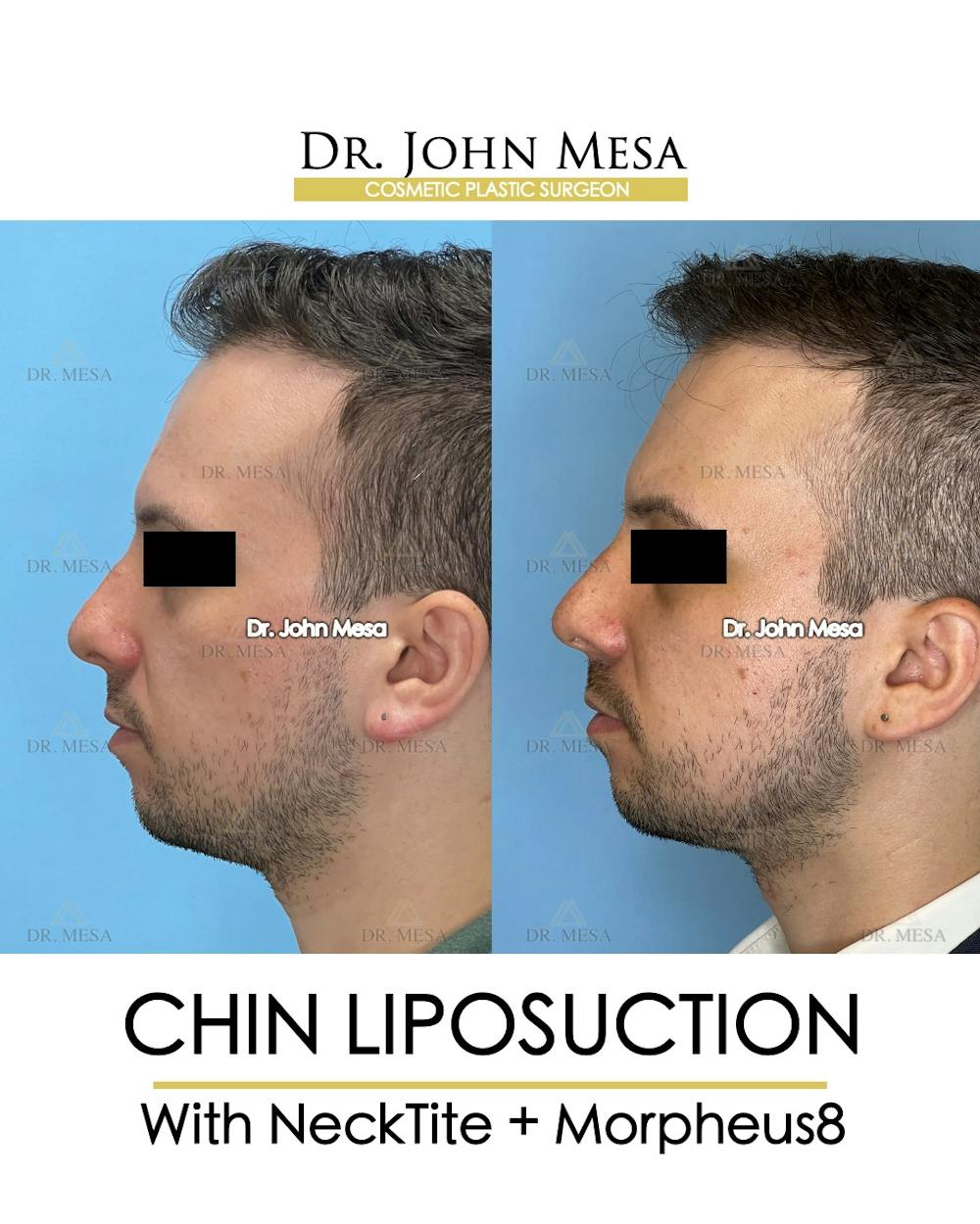Chin Liposuction Before & After Gallery - Patient 174902009 - Image 5