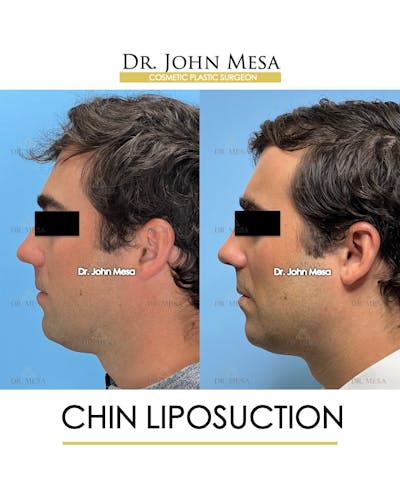 Chin Liposuction Before & After Gallery - Patient 174902005 - Image 4