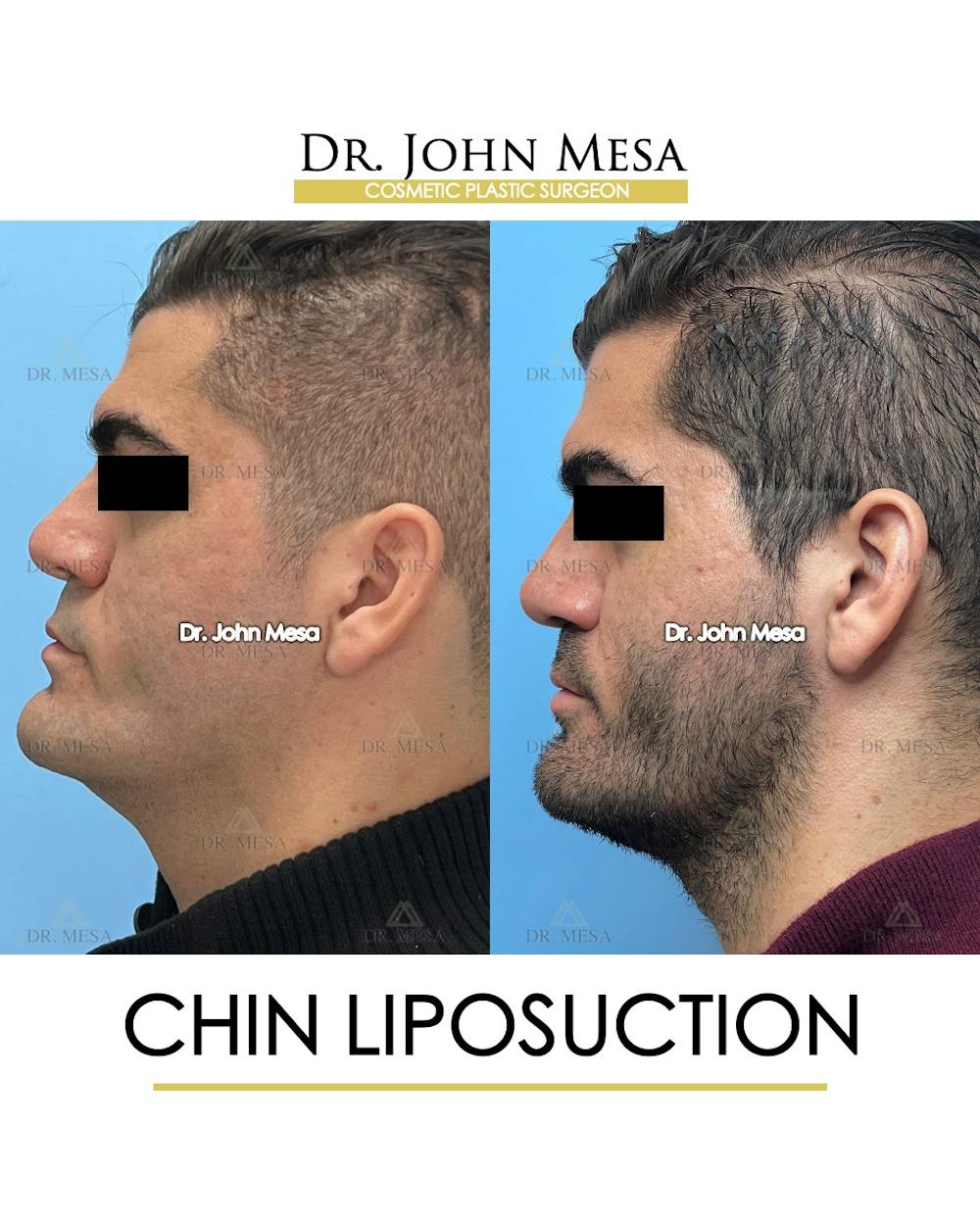 Chin Liposuction Before & After Gallery - Patient 174902008 - Image 5