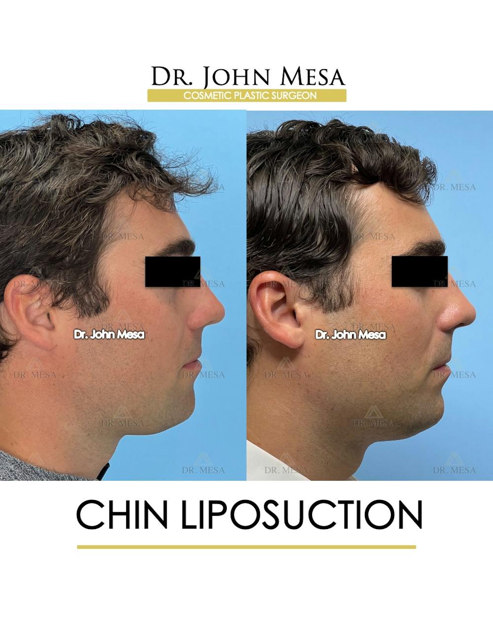 Chin Liposuction Before & After Gallery - Patient 174902005 - Image 1