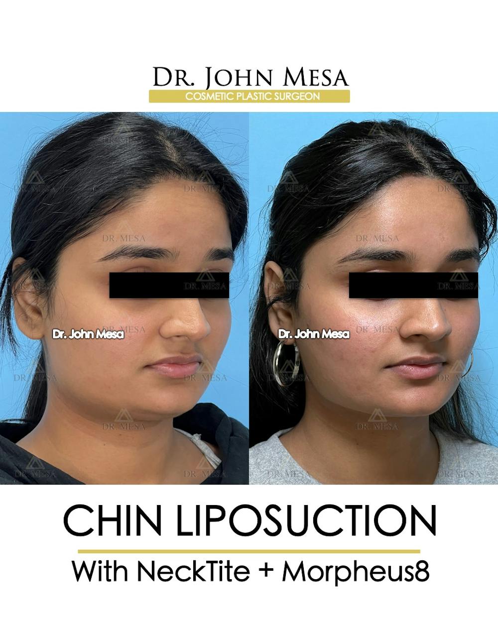 Chin Liposuction Before & After Gallery - Patient 174902185 - Image 3