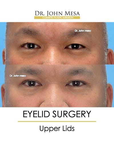 Eyelid Surgery Before & After Gallery - Patient 174902413 - Image 1