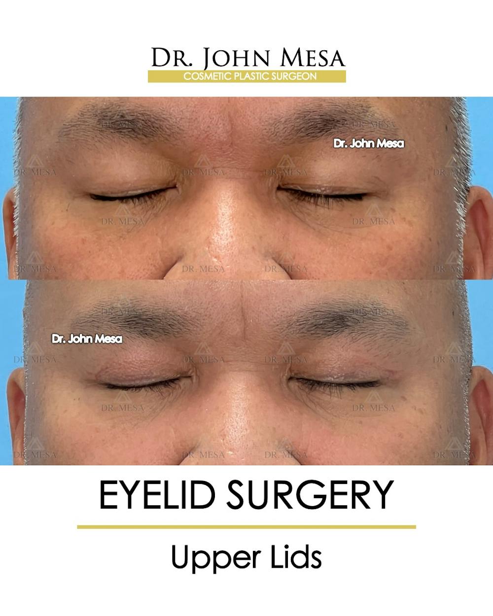 Eyelid Surgery Before & After Gallery - Patient 174902413 - Image 2